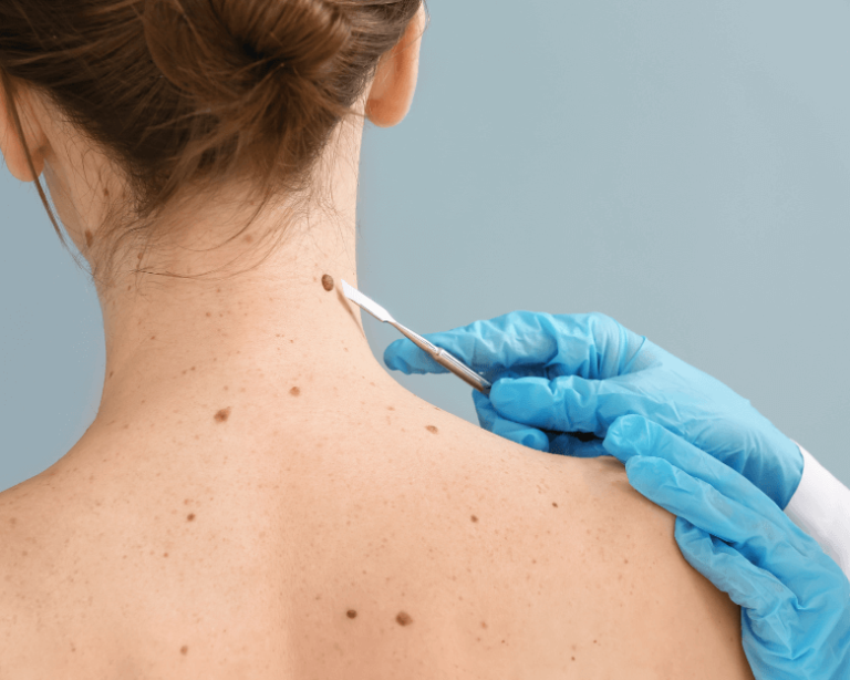 Skin Cancer & Cosmetic Treatments on the Gold Coast